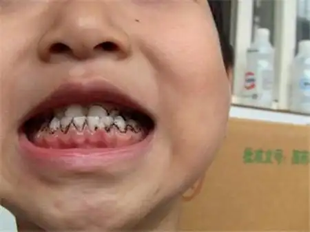 小孩子牙龈发黑图片