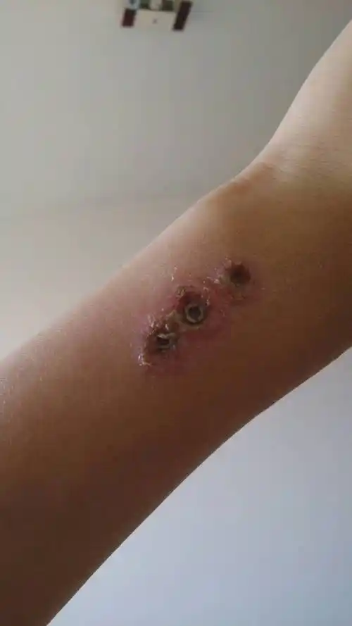 我这个胳臂用烟烫的,现在是什么情况?