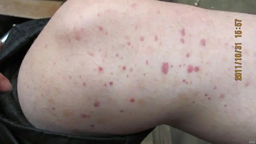 主诉:双下肢出血点一个月余  现病史:一个月前发现双下肢皮肤有出血点