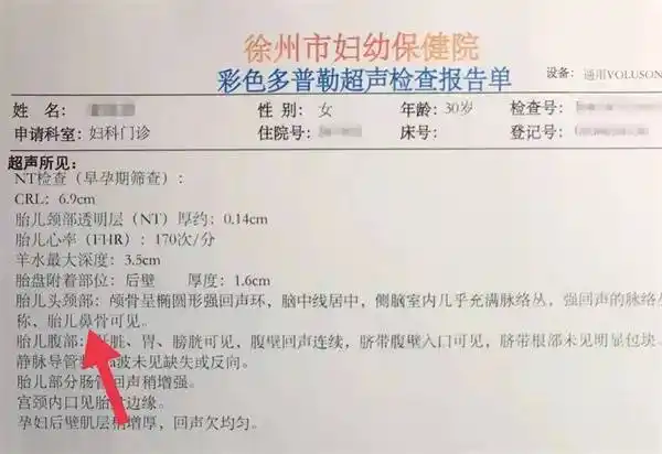 胎儿鼻骨是筛查染色体异常的指标之一.鼻骨长短及骨化程度与孕龄有关.