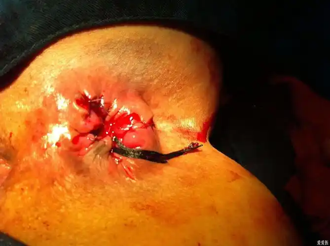 重度混合痔图片