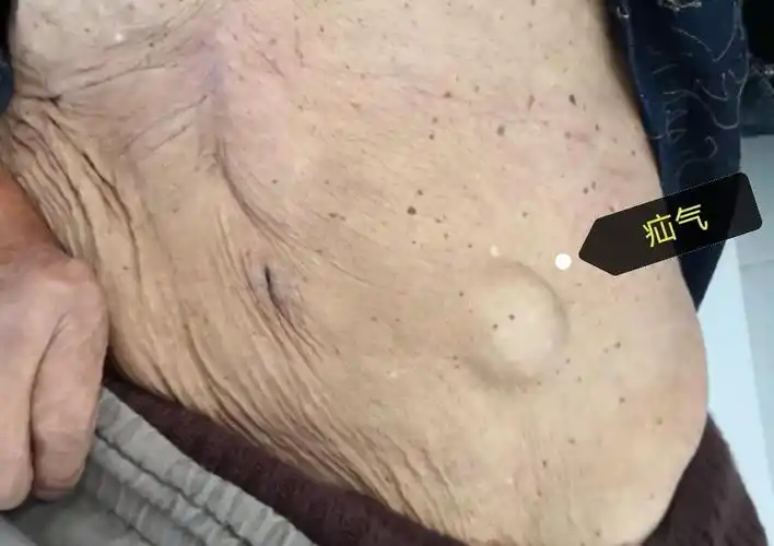 下图剪头所指的鼓包是疝气专家门诊:每周三全天东南大学附属中大医院