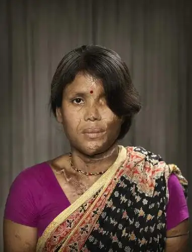 来自印度的不幸,摄影师拍下许多被硫酸毁容的人,尤其是女性的伤害最大