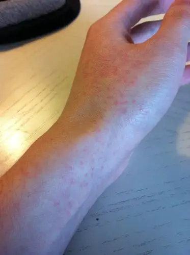 主要症状等):11号晚上发烧,第二天发现全身发红疹,不痒不痛,除了腿上