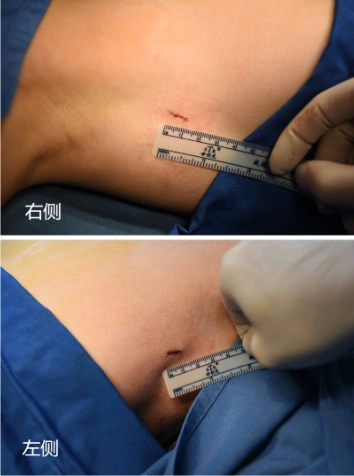 广药大附一院"切口"牵线    手汗症的治疗方法包括保守治疗和手术治疗