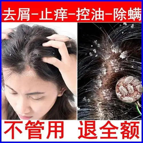 毛囊炎洗发水奋达洗剂头皮癣去头皮屑毛囊炎洗发水头癣脂溢性皮炎专用