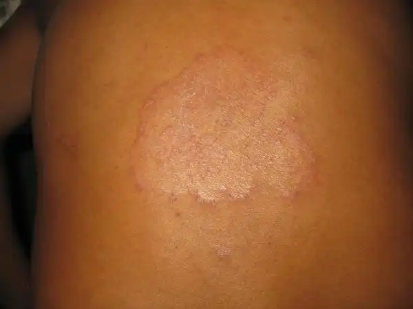 股藓与湿疹图片鉴别