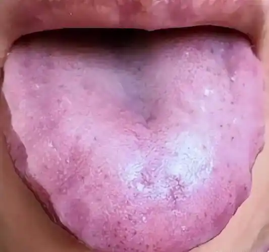 舌象告诉你_血瘀_气虚_什么