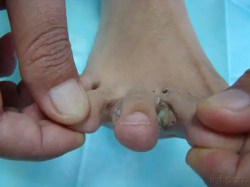 足趾间赘生物