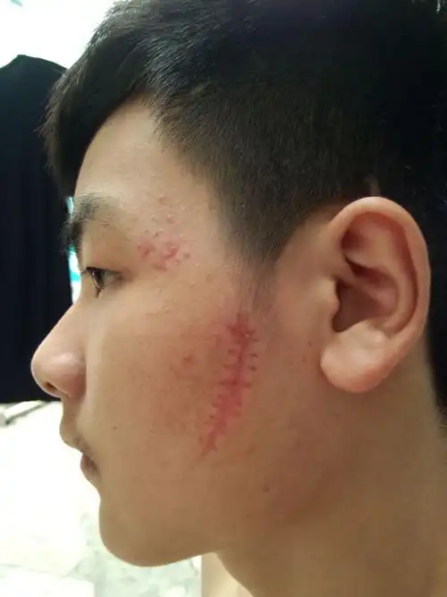 脸上有疤痕!能不能去掉?