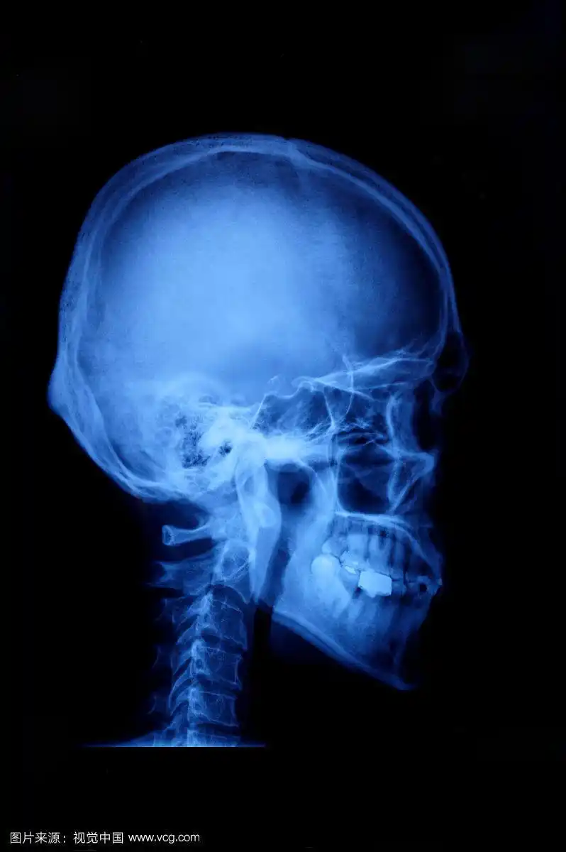 x光,人物头部