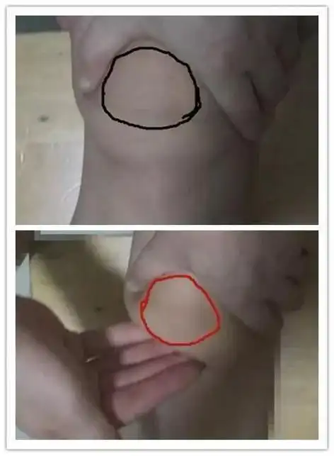 67你的膝关节也有肥胖症髌下脂肪垫炎