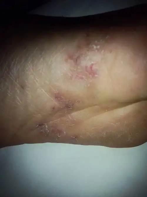 脚底痒起泡,大师给诊断下是什么病,该怎么治,谢谢!