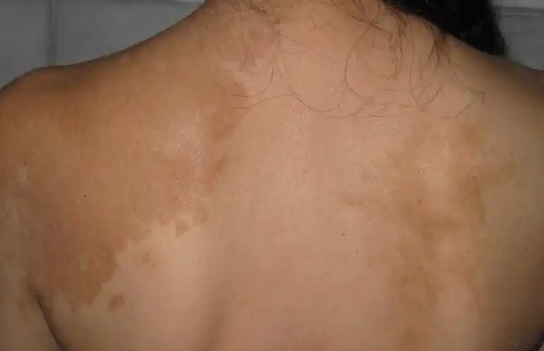 图片分享色素性毛表皮痣