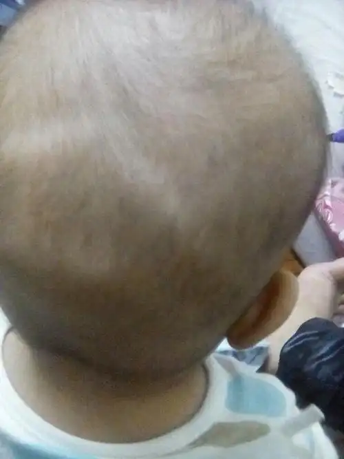 宝宝的后脑突出来怎么回事?像锥形似的,摸起来骨头很硬