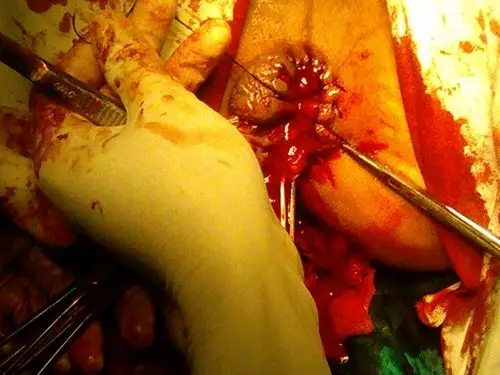 北京外痔医院_北京治疗外痔哪家医院好_北京治疗外痔最