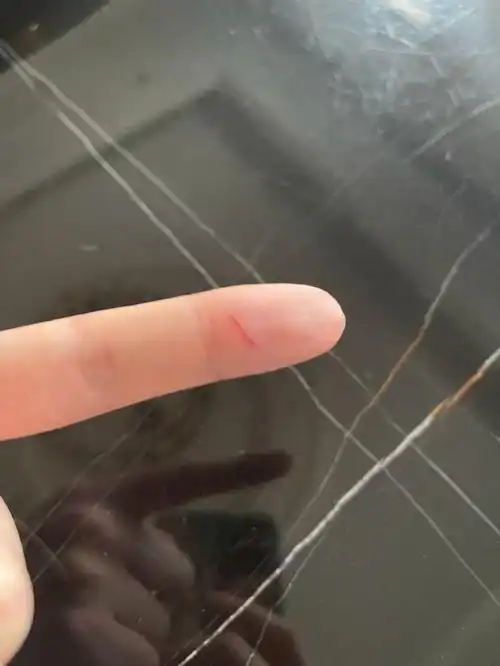 分享了最新动态竟是受伤的手指,并且是二度受伤,在继被刮胡刀划伤之后