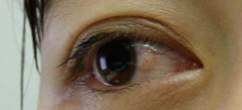 睑裂斑炎症表现-眼睛红血丝_眼球红血丝_眼白红血丝去除-young cells