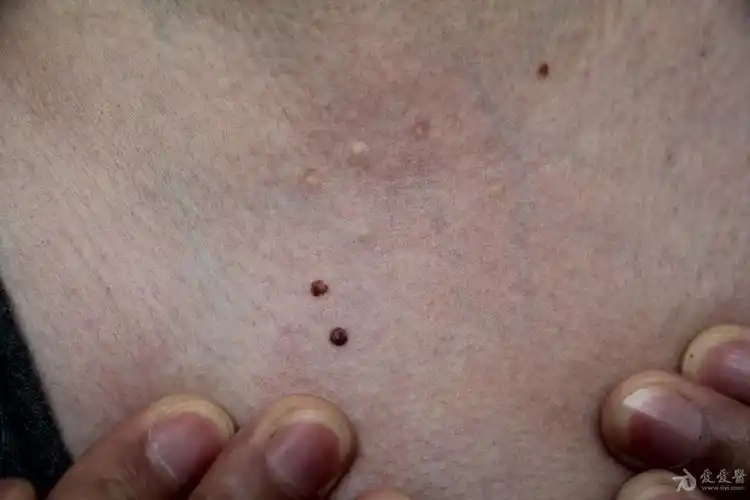 常见病皮肤脂囊瘤