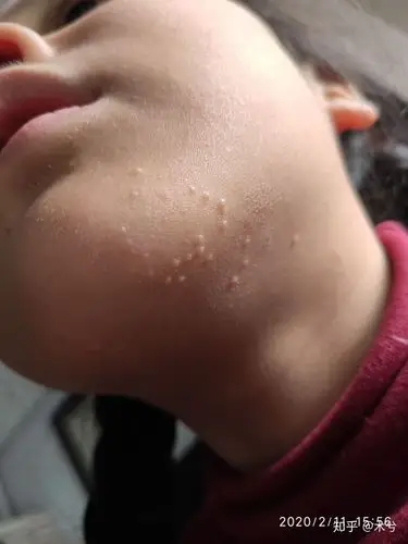 2人 赞同了该文章 2019年冬天,大概是十一月中旬发现下巴有一些小疙瘩