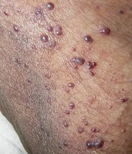 男性外生殖器皮肤丘疹/肿瘤/囊肿之诊断