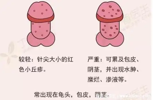 早期龟头炎症状图片对照,长红点水疱会瘙痒溃烂(6种类型)
