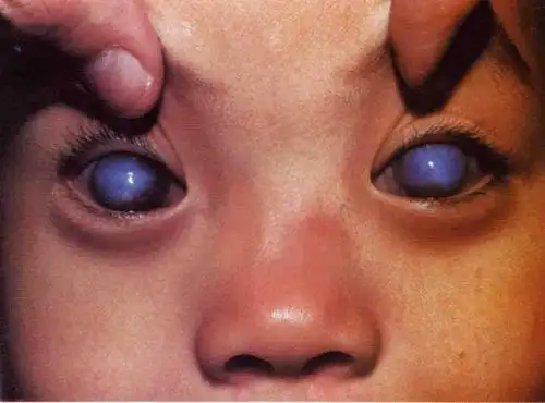 青光眼不只是一种眼疾,而是一组导致视神经损伤的眼睛状况,它会引起