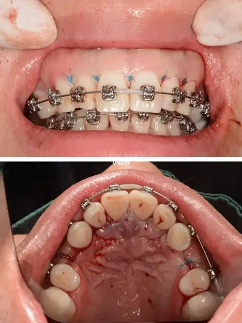 患者为了做矫正,毅然决定拔除多年来不痛不痒的多生牙,超声骨刀下微创