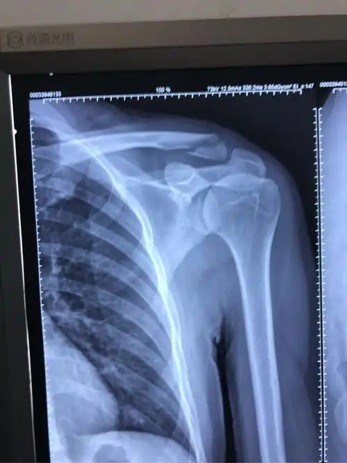锁骨远端骨折片子如图求给意见欢迎讨论