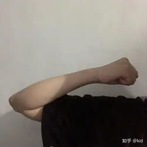 尺骨鹰嘴骨折三个月五个月的变化