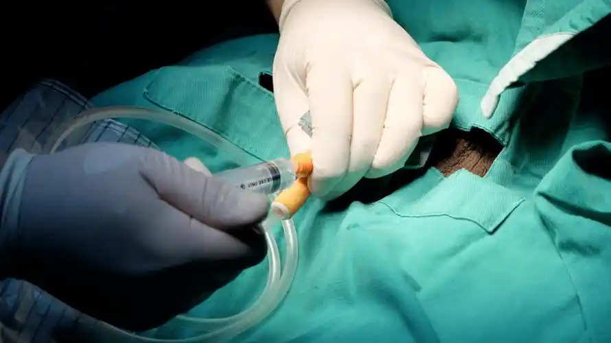 插上尿管后,医生让吴英回家自主导尿.这意味着,她以后要以尿袋为伴了.