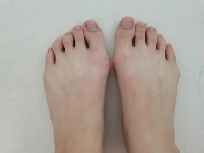 脚趾外翻矫正器有用吗(儿童脚趾外翻矫正器有用吗)-情感知识库-动动脑