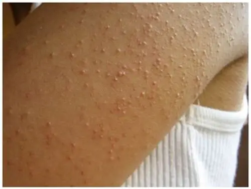 毛周角化症图片39