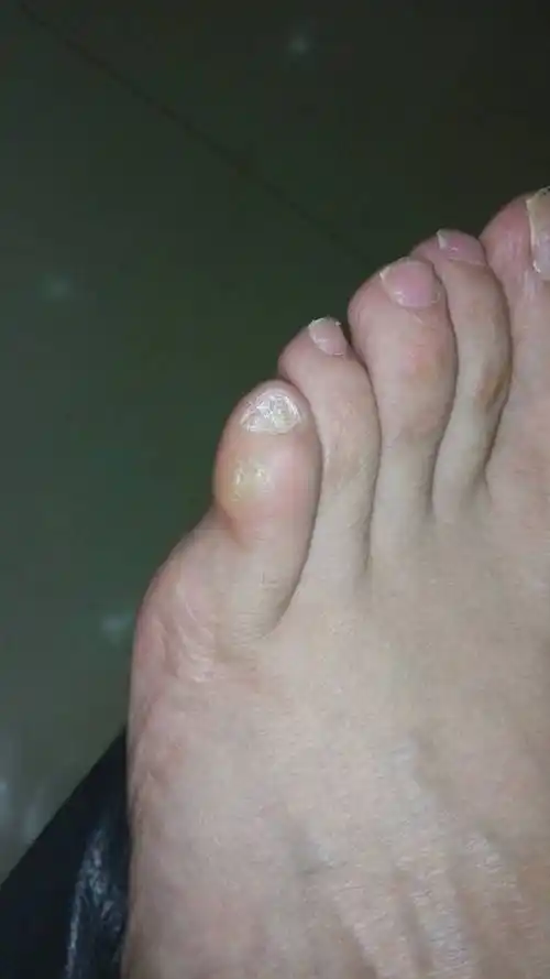 我脚那个小指旁边是什么 穿鞋子好痛 走路也痛 好烦