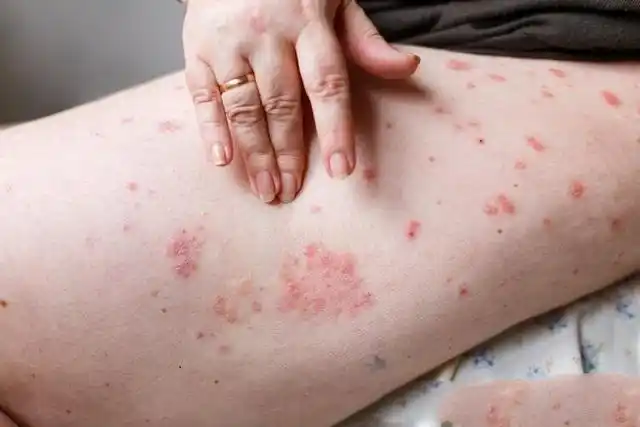 点滴型银屑病症状图片_银屑病求医网