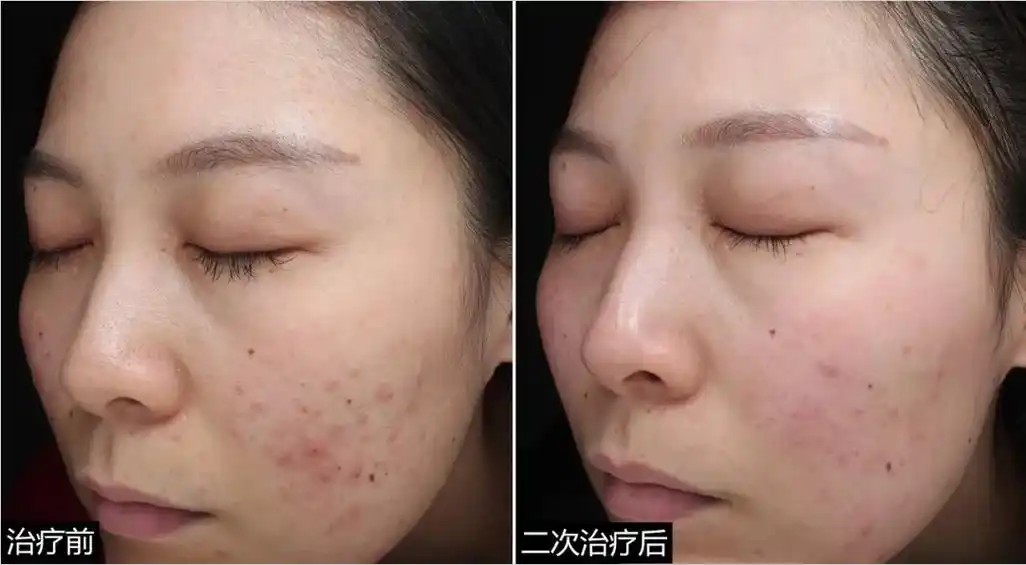 光子嫩肤原理是怎么样的,术中疗程如何?术后多长时间能出效果?