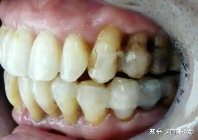 牙龈萎缩成这样,还能正畸吗?