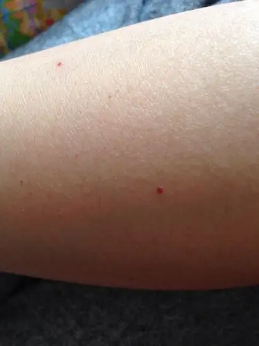 身上很多红血点很小就有了不痛不痒请