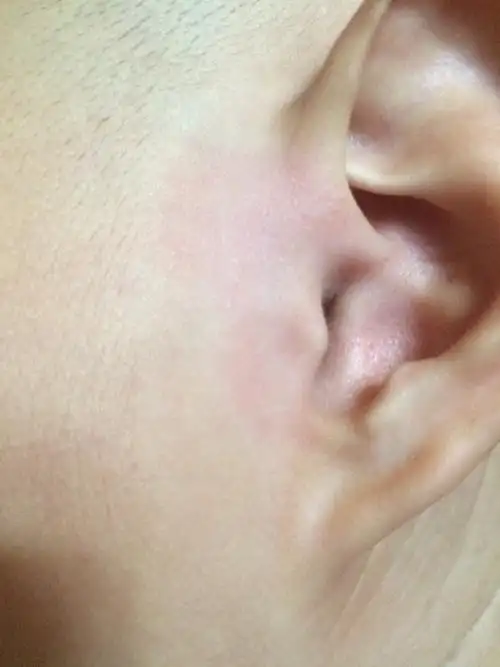 两岁宝宝耳屏位置红肿疼怎么回事,昨天洗澡时擦耳朵疼的直哭,发现时