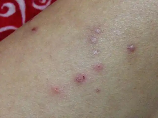 瘙痒|皮损|皮炎_网易订阅