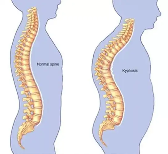 改善「富贵包」,别让你的颈椎再废下去了
