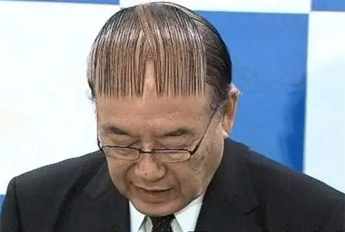 长春青年秃顶指南 | 第一批90后已经开始秃了.