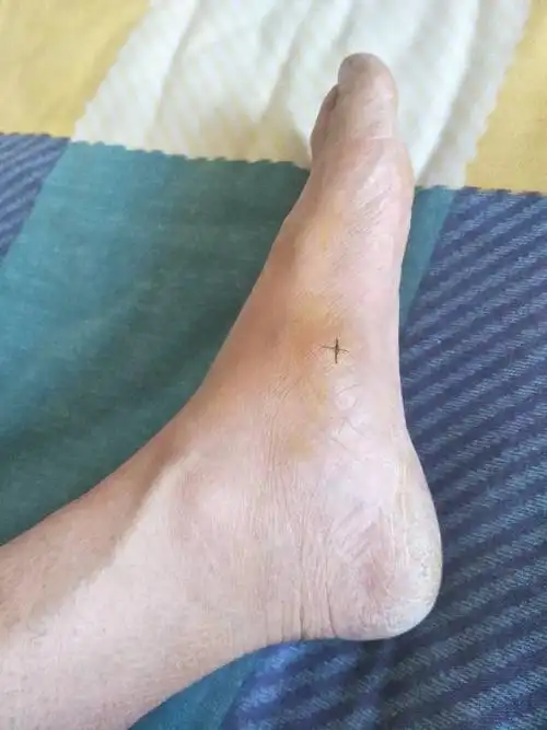 行走中左脚内侧被扎了,十几天了还痛肿