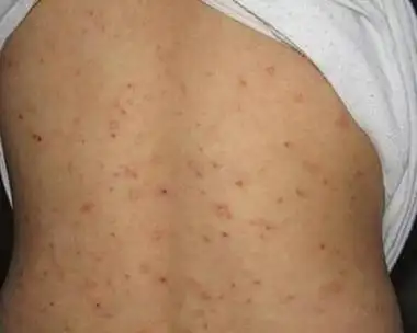 疥疮是疥螨引起的传染性皮肤病.