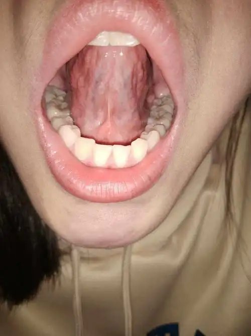 正常舌头下面青筋图片