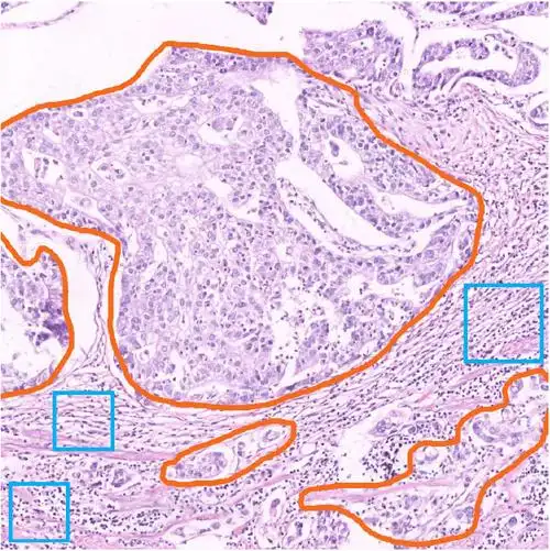 图4-1 胃癌病理切片