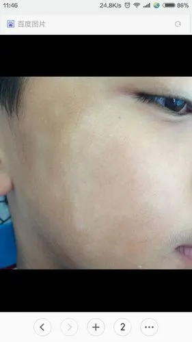 脸上有白块 今年16岁,这种情况好几年了,不知道是