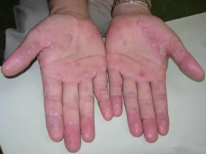 男性艾滋病症状手癣脚癣真菌感染