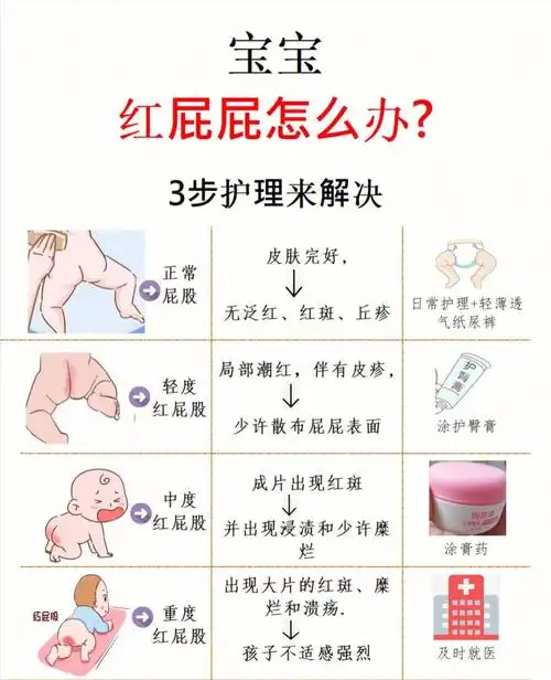 红屁股又称作尿布疹,属于皮肤炎,症的一种,多发于2岁以内宝宝的臀部