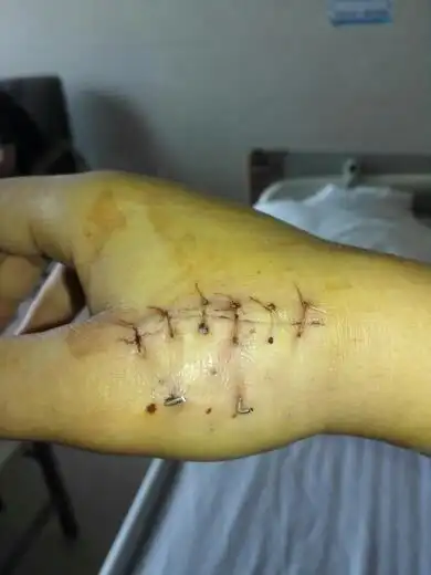 第一第五掌骨骨折上周三做了骨折手术克氏针固定.